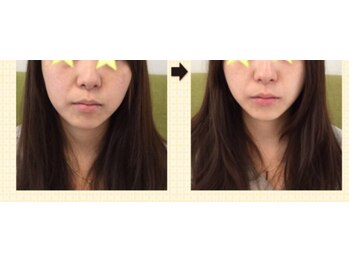 ルクラ(Lucura)/歪みケアでスッキリ小顔