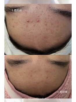 マウム(Maum)/剥かないニキビケア★