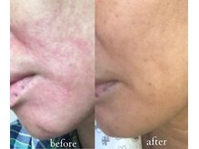 トリートメントルーム フェリーチェ(Felice)/更年期の肌荒れ