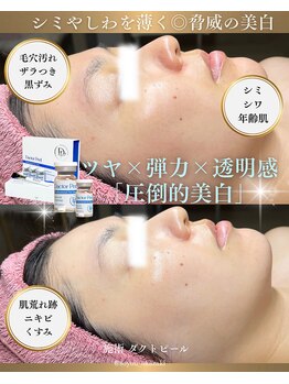 ソユ(SOYOU)/施術* ダクトピール