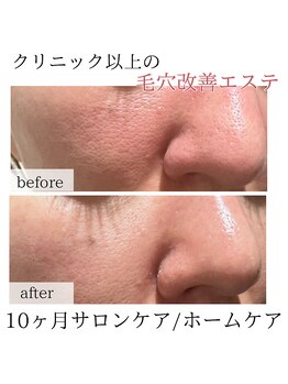 サロン イナンナ(Salon INANNA)/開き毛穴/毛穴エステ/尾張旭