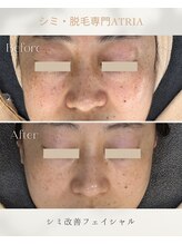 アトリア(ATRIA)/シミ改善フェイシャル