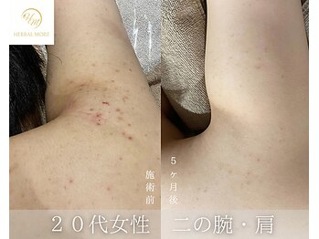 肌耕/二の腕のハーブピーリング