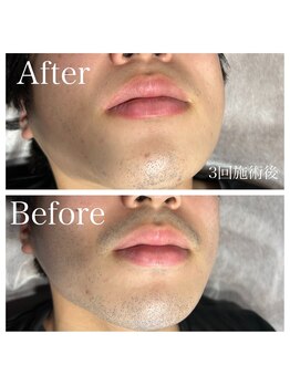 エピノン 山口岩国店(Epinon)/顔脱毛3回ビフォーアフター