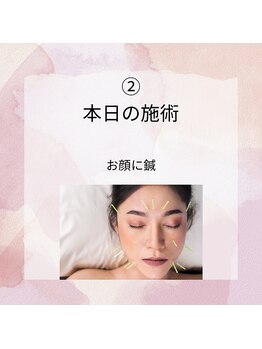 リローゼ(Re.ROSE)/お悩みに合わせた箇所へ鍼