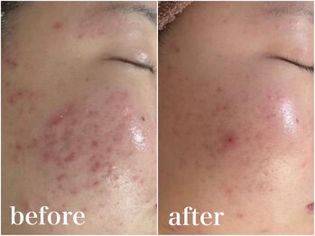 アワピール 成田公津の杜店(AWA PEELL)/ハーブピーリング/ニキビケア