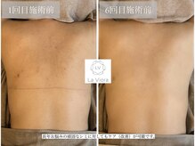 ラヴィオーラ 明石店(La Viora)/ダイヤモンドハーブピーリング