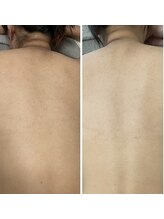 ケイサロン 朝霞店(K salon)/【背中ケア】Before・After