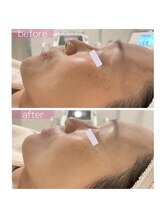 ペルラペティーユ(PERLA PETILLER)/ヒト幹細胞培養エキス導入