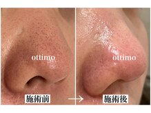 オッティモ(ottimo)/毛穴洗浄