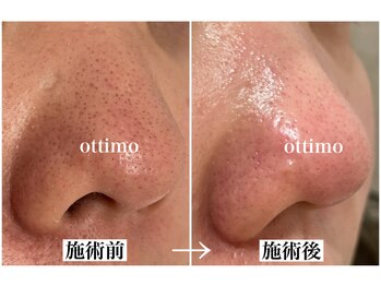 オッティモ(ottimo)/毛穴洗浄