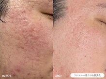 フォンビューティー(fon beauty)/ニキビ&凹凸ケア×4回