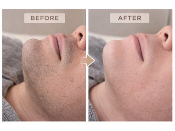 フォーグッド(forgood)/青ヒゲのお悩みに