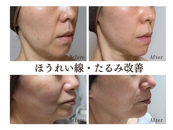 エボルブ 四条烏丸店(EVOLVE)の写真/そのホウレイ線、諦めていませんか？幹細胞美容のプロにお任せ◎加齢に伴うたるみケア・ほうれい線撃退！