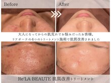 ミエル 神戸店(Miel)の雰囲気（ニキビ悩みのお客様もお任せください。肌の土台から根本改善を。）