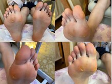 ビサンテ サロン/酷い魚の目,たこ,踵に角質ケア前