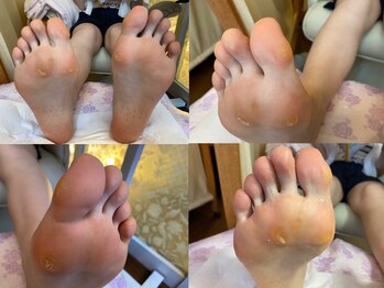 ビサンテ サロン/酷い魚の目,たこ,踵に角質ケア前