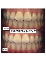 エスデザイン(es design)/セルフホワイトニング／鹿児島