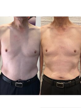 長寿鍼灸院 長寿整骨院/EMS＜お腹集中コース＞