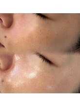 ルチル 八女店(Rutile)/シミやくすみケア