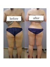 アップルミント/＜痩身＞before・after