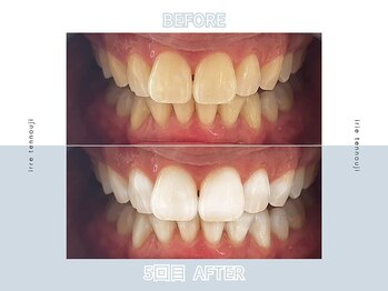 アイリー ホワイトニング 難波店/セルフホワイトニング☆クーポン