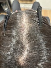 フォーケア(4Care)/プロセル頭皮改善トリートメント