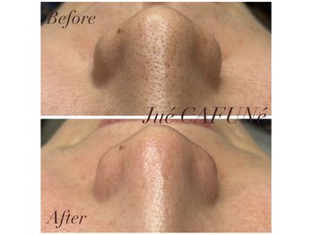 ジュエカフネ 広尾(JueCAFUNe)/毛穴再生で目指せ毛穴レス！