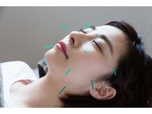 北千住整骨院の雰囲気（50本近い鍼を使用してたるんだお肌、皮膚を引き上げます◎）