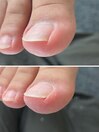 陥入爪による痛みを改善へ