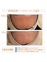 ソワン(soin)/肌質改善ハーブピーリング/2回目