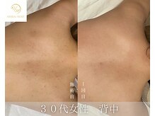肌耕/背中のハーブピーリング