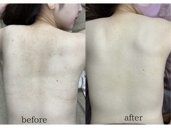 ルブレ Ginza5店(RUBURE)/【背中脱毛ビフォアフター】