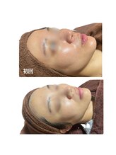 ヴィヴィエ 佐賀店(ViVier)/ララピール症例4回目