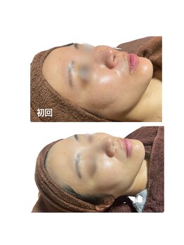 ヴィヴィエ 佐賀店(ViVier)/ララピール症例4回目