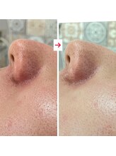 ハズキ(HAZUKI)/ハーブピーリング脱】鼻の黒ずみ