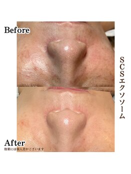 サロンゼロ 池上店(Salon ZERO)/SCSエクソソームでシミ改善！