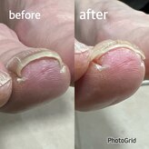 北区天神橋巻き爪センター