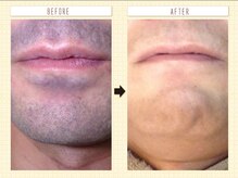 大人気のヒゲ脱毛◎