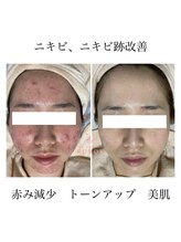 【美肌脱毛/シミケア/ニキビ肌改善エステ/ハーブピーリング】RUBON宮崎店/RUBONのニキビケアエステ