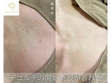 肌耕/デコルテのハーブピーリング