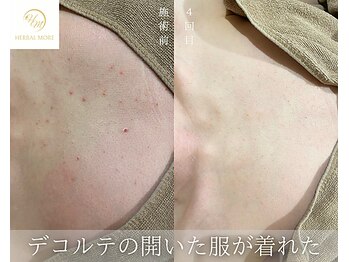 肌耕/デコルテのハーブピーリング