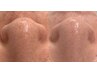 【黒ずみ毛穴・開き毛穴ケアに】毛穴スッキリコース