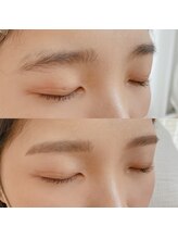 ニコプラス(nico+)/困り眉改善