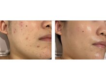 アドビューティ(Add Beauty)/≪プラズマフェイシャル≫