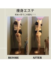 ムーン(MOON)/痩身エステbefore→after