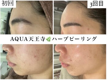 ホワイトアクア 天王寺本店(WHITE AQUA)/ハーブピーリング/大阪/天王寺