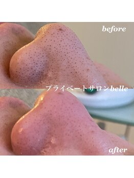 ベル(belle)/毛穴エクストラクション