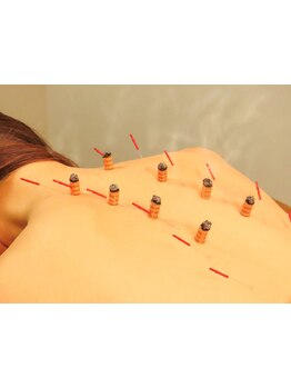 鍼灸施術を受けたい