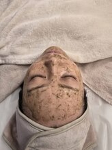 ララ(RARA)/バーブピーリングもおすすめ♪